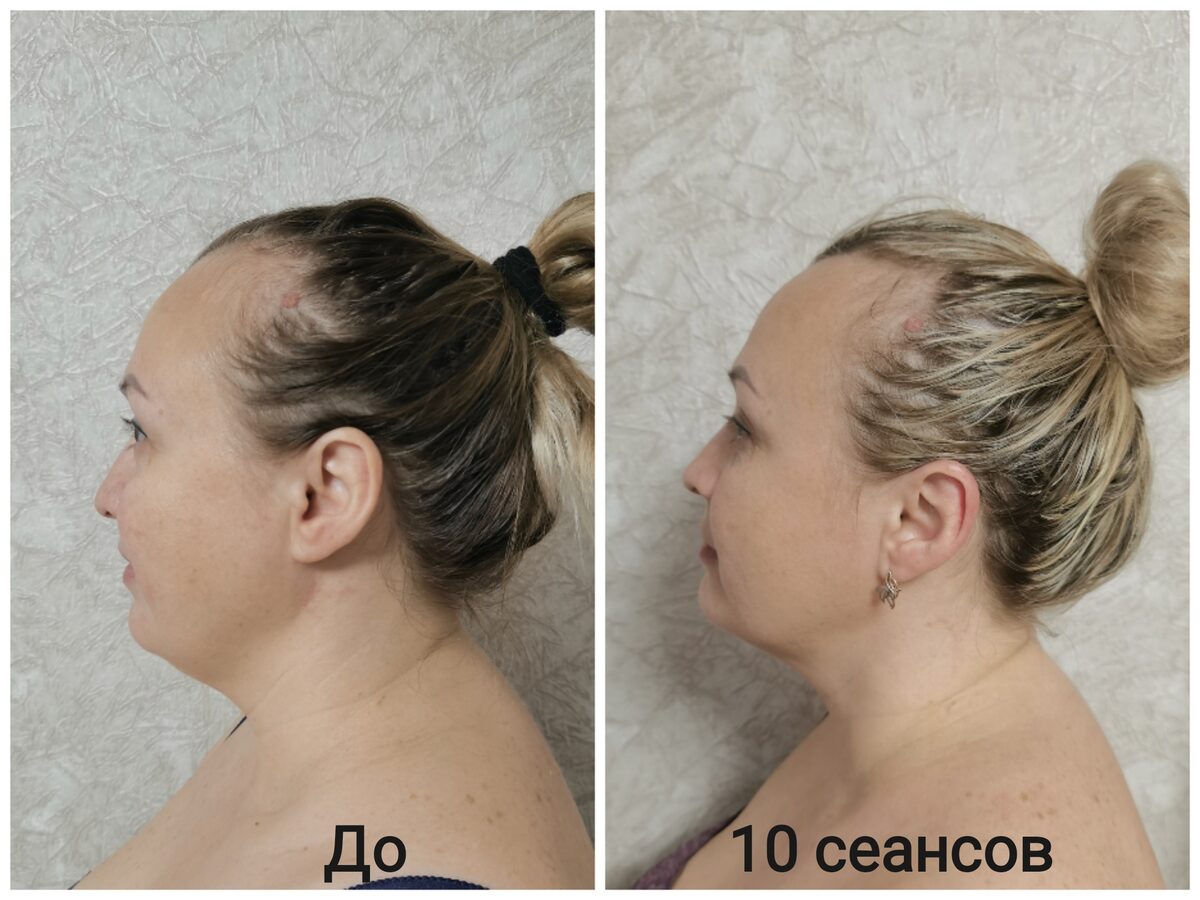 До и после: профиль лица, 10 сеансов