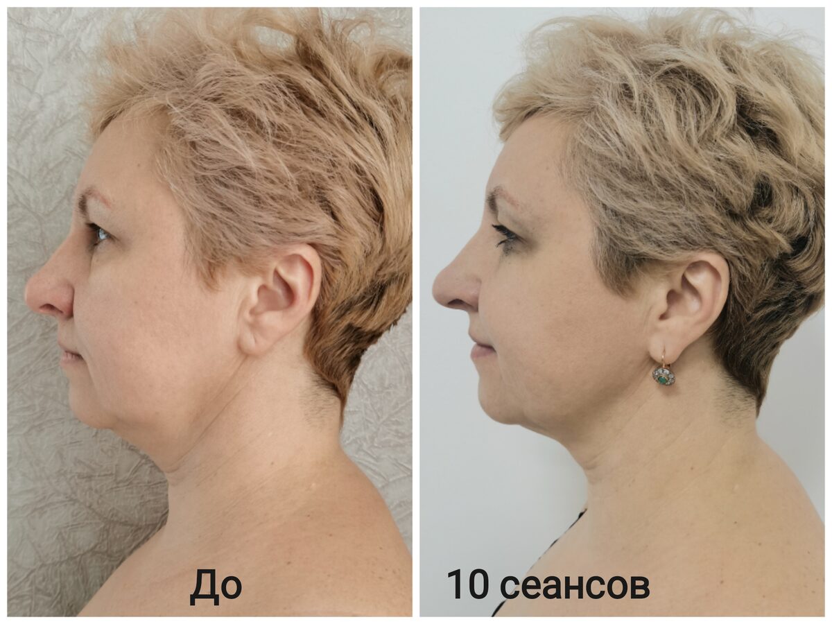 До и после: профиль лица, 10 сеансов